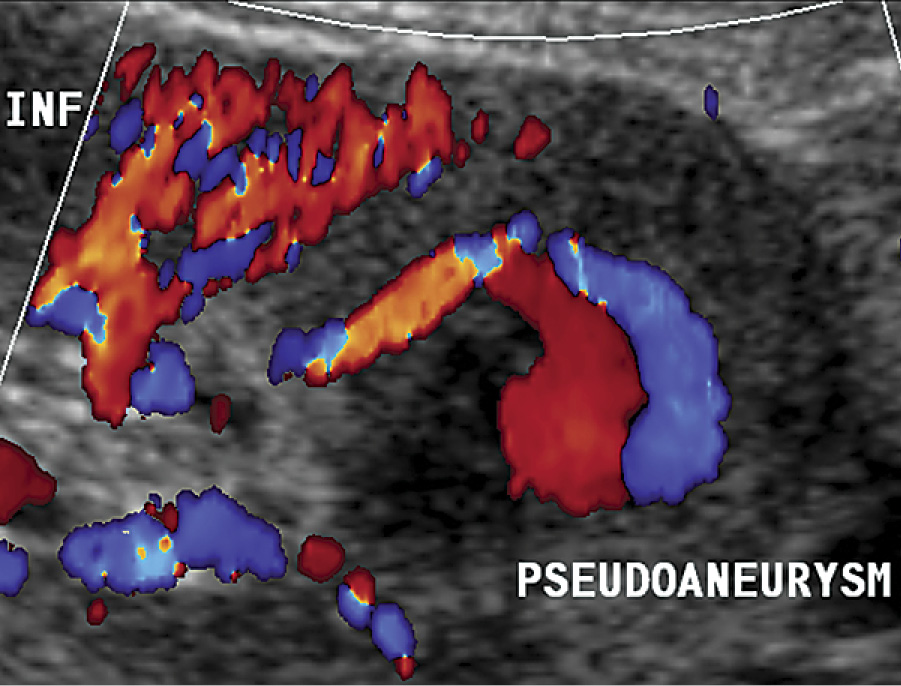Pseudoaneurysm in a 14-year-old female after renal transplantation Pseudoaneurysm in a 14-year-old female after renal transplantation